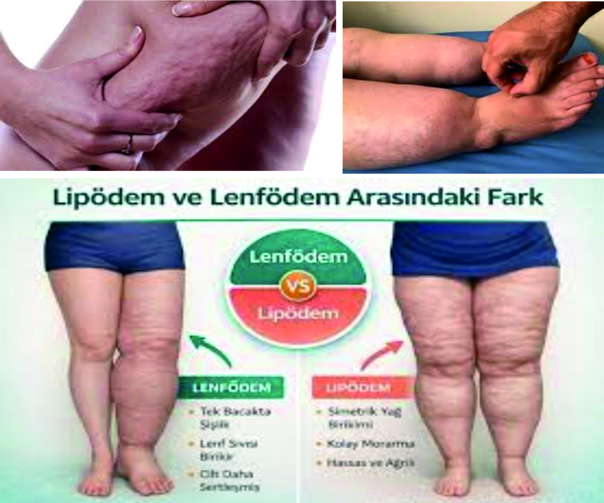 LİPÖDEMLİ HASTALARDA VARİS SORUNU: TEDAVİDE ÖNCELİK NE OLMALI?